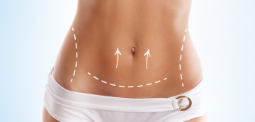 Bauchdeckenstraffung - Dr. med. Bromba im KH in Essen (NRW)