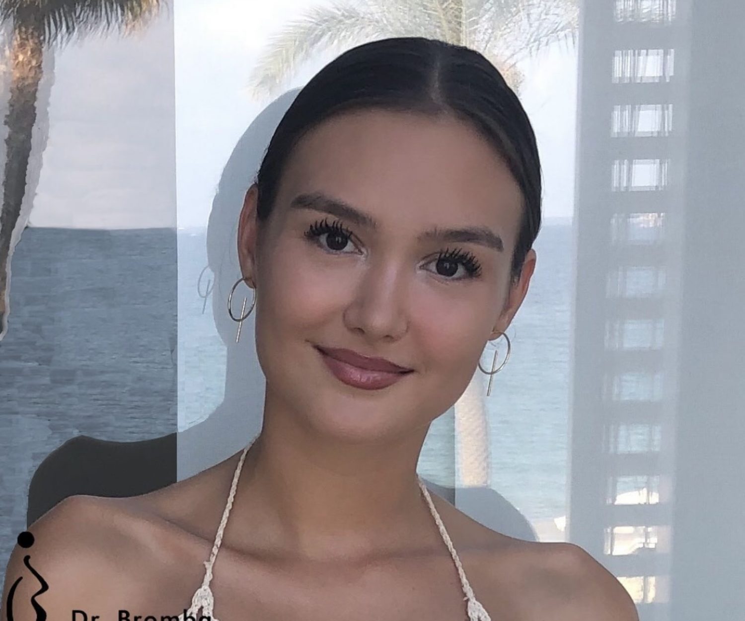 Bild nach einer Nasenoperation durch Dr.Bromba